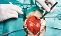 عمل جراحی خارج کردن تومور قلبی 